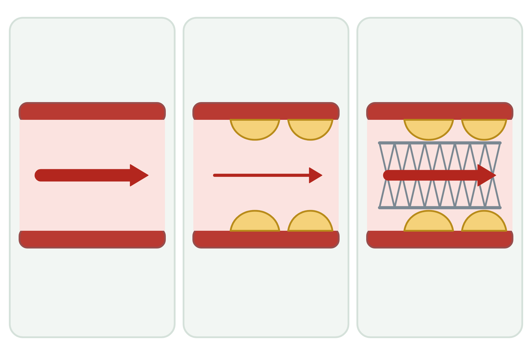 A healthy, a narrowed and a stented artery with no labels.