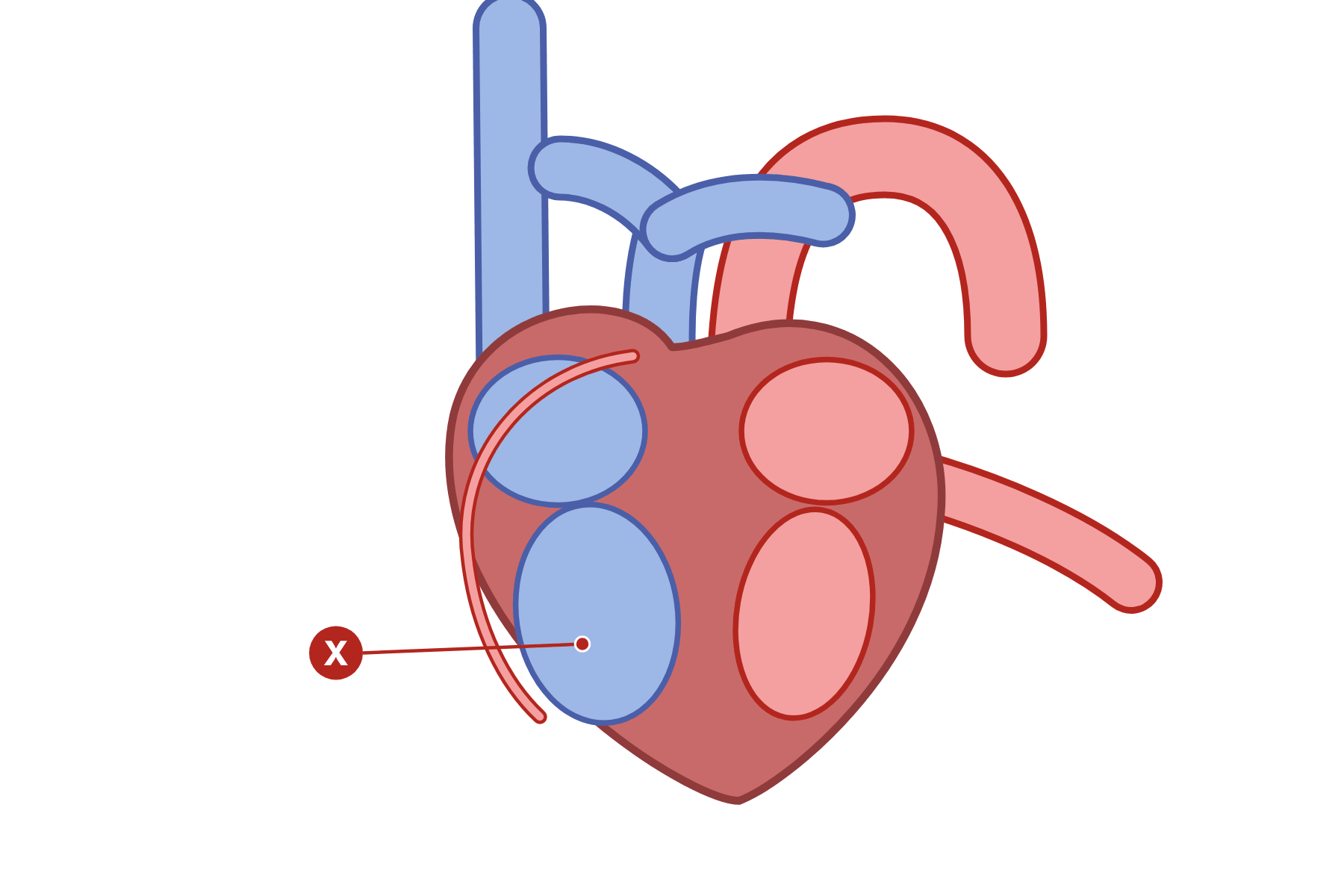 A heart with a pointer marked X to the right ventricle.