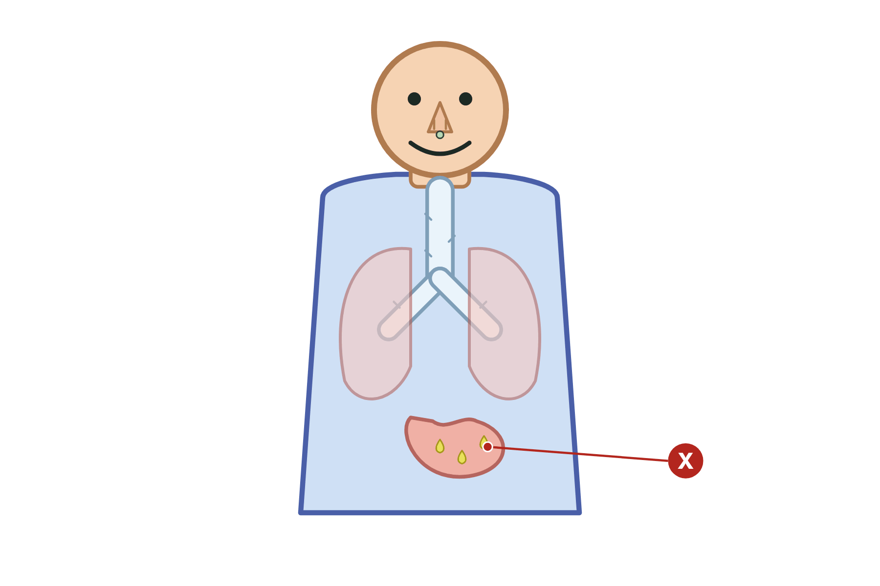 A body with a pointer marked X to the stomach.