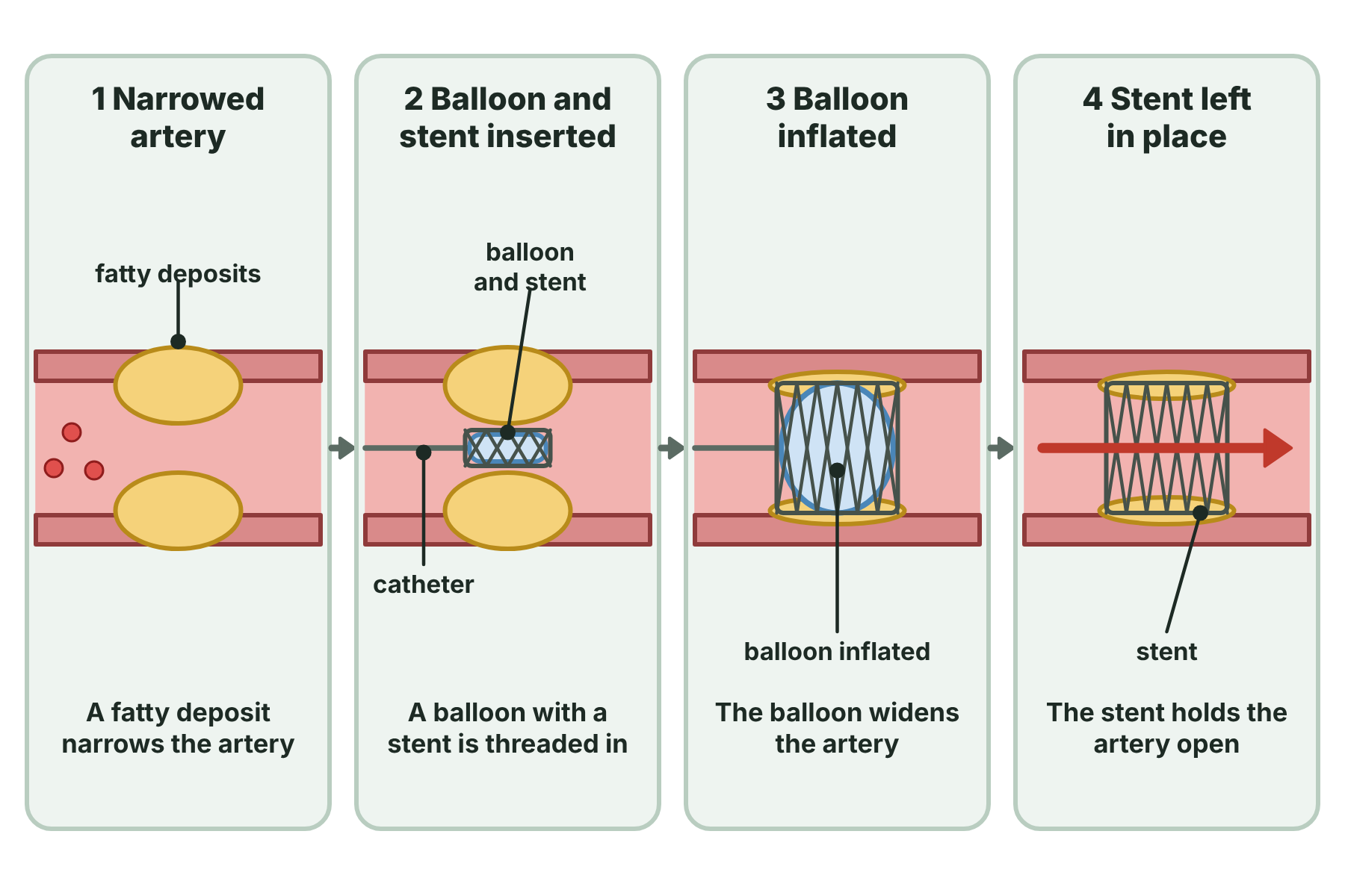 Four stages of angioplasty: a narrowed artery, a balloon and a stent put in place, the balloon inflated, and the stent left in the artery holding it open.