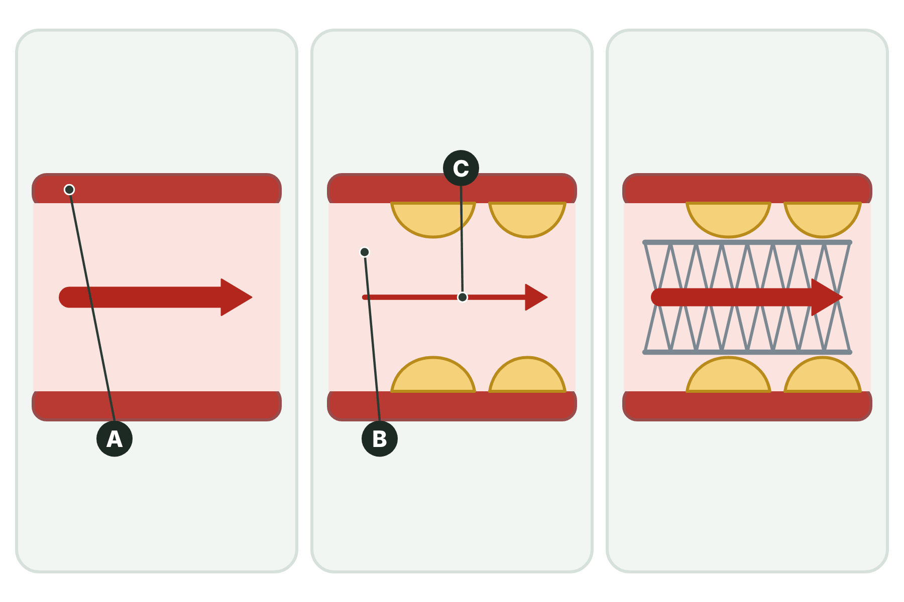 Three coronary arteries with three parts marked A, B and C.