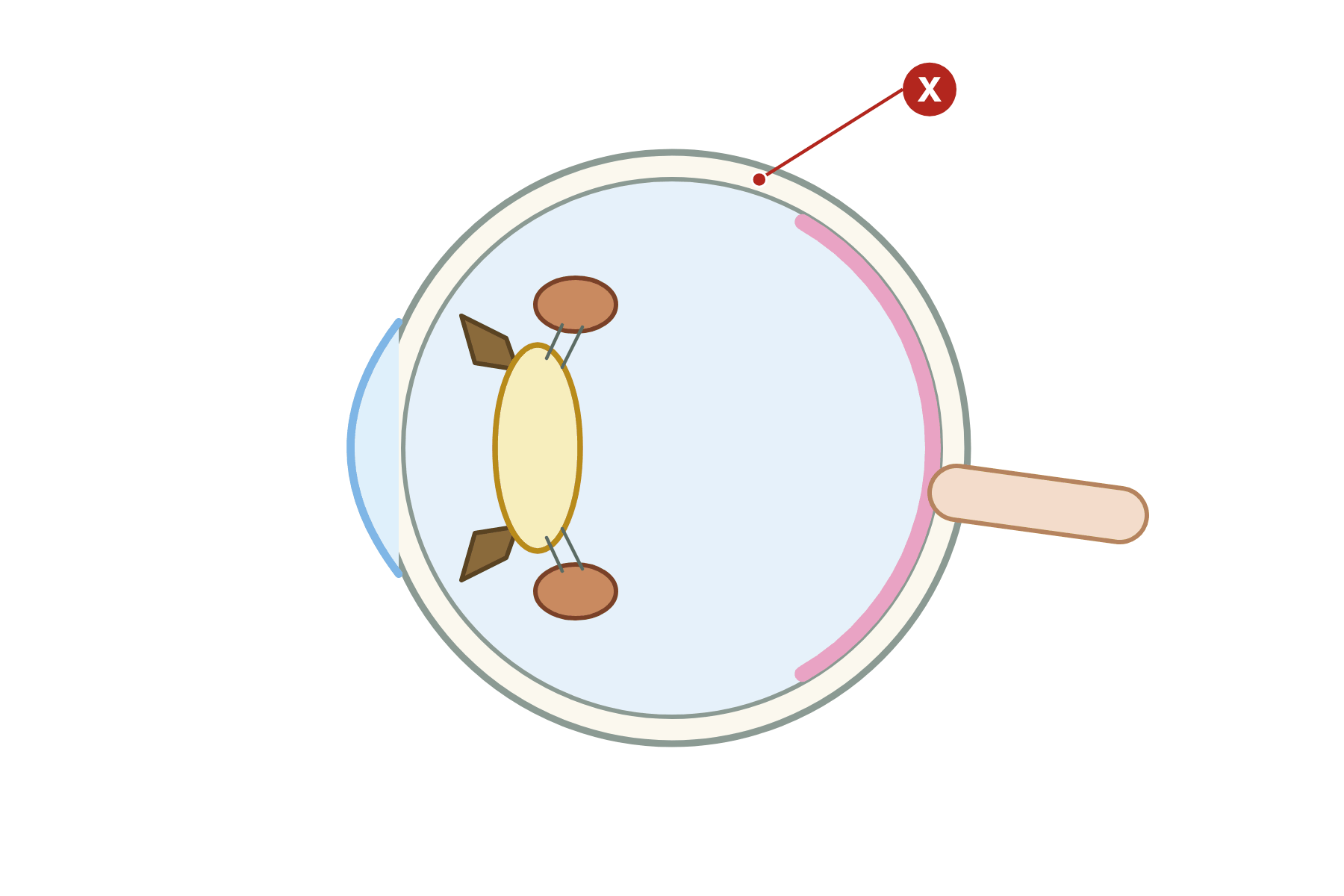 The eye in cross-section with a pointer marked X to the sclera.