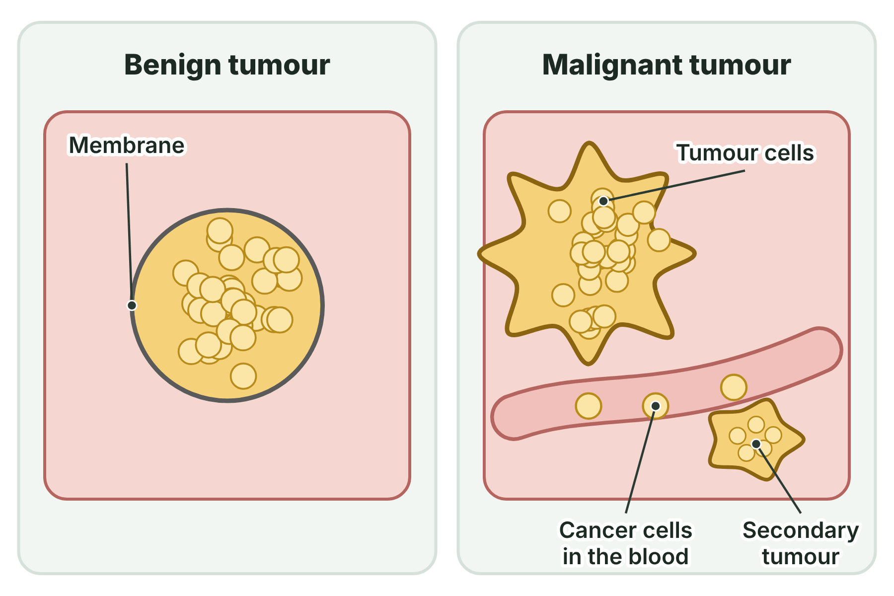 A benign tumour contained in a membrane, and a malignant tumour that invades the tissue around it, sends cells in the blood and forms a secondary tumour.