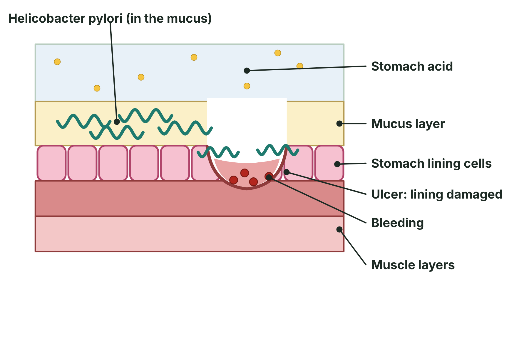 A cross-section of the stomach wall with Helicobacter bacteria in the mucus layer and an ulcer where the lining has been damaged.