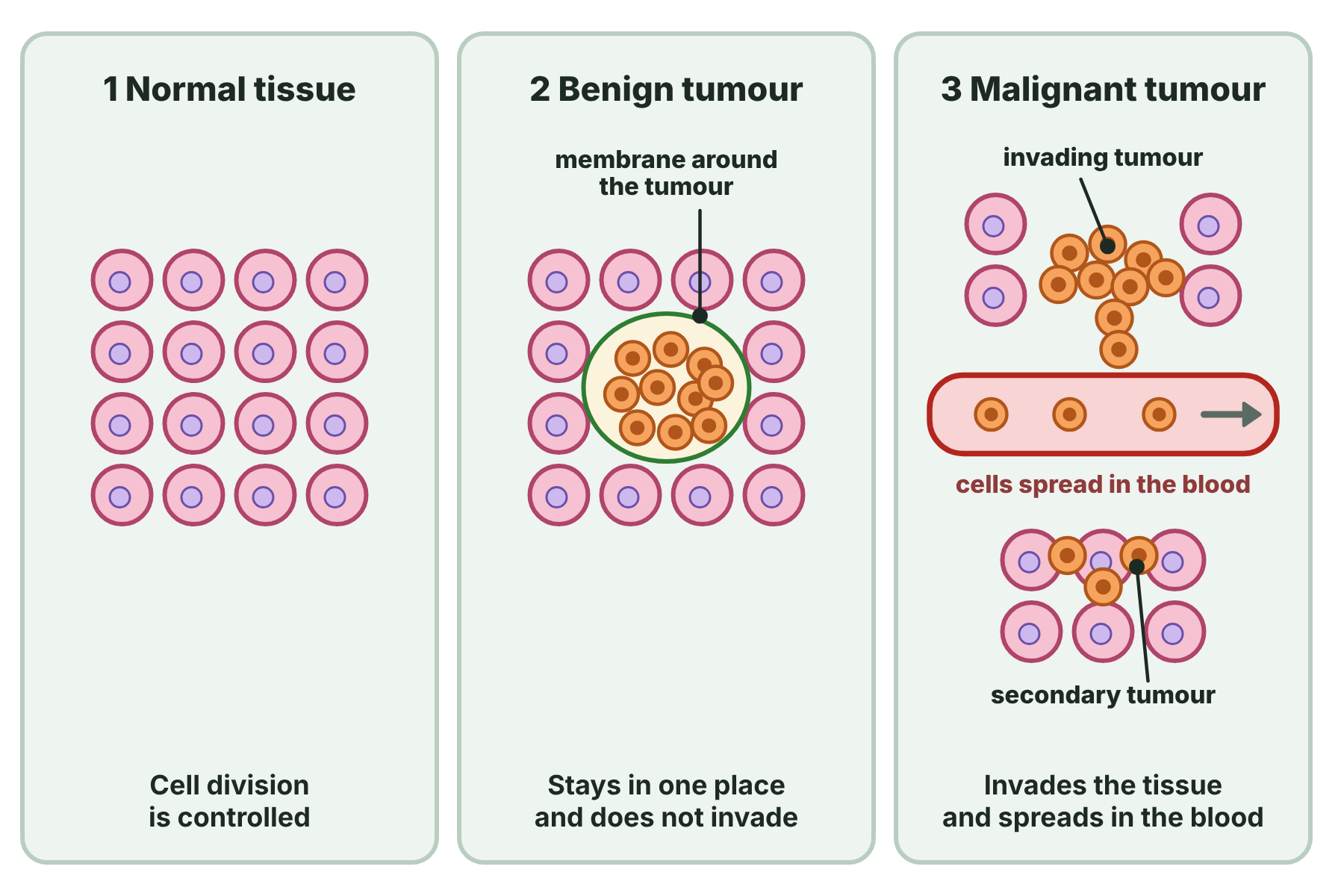 Normal tissue, a benign tumour in a capsule, and a malignant tumour that invades the tissue and spreads through the blood to form a secondary tumour.