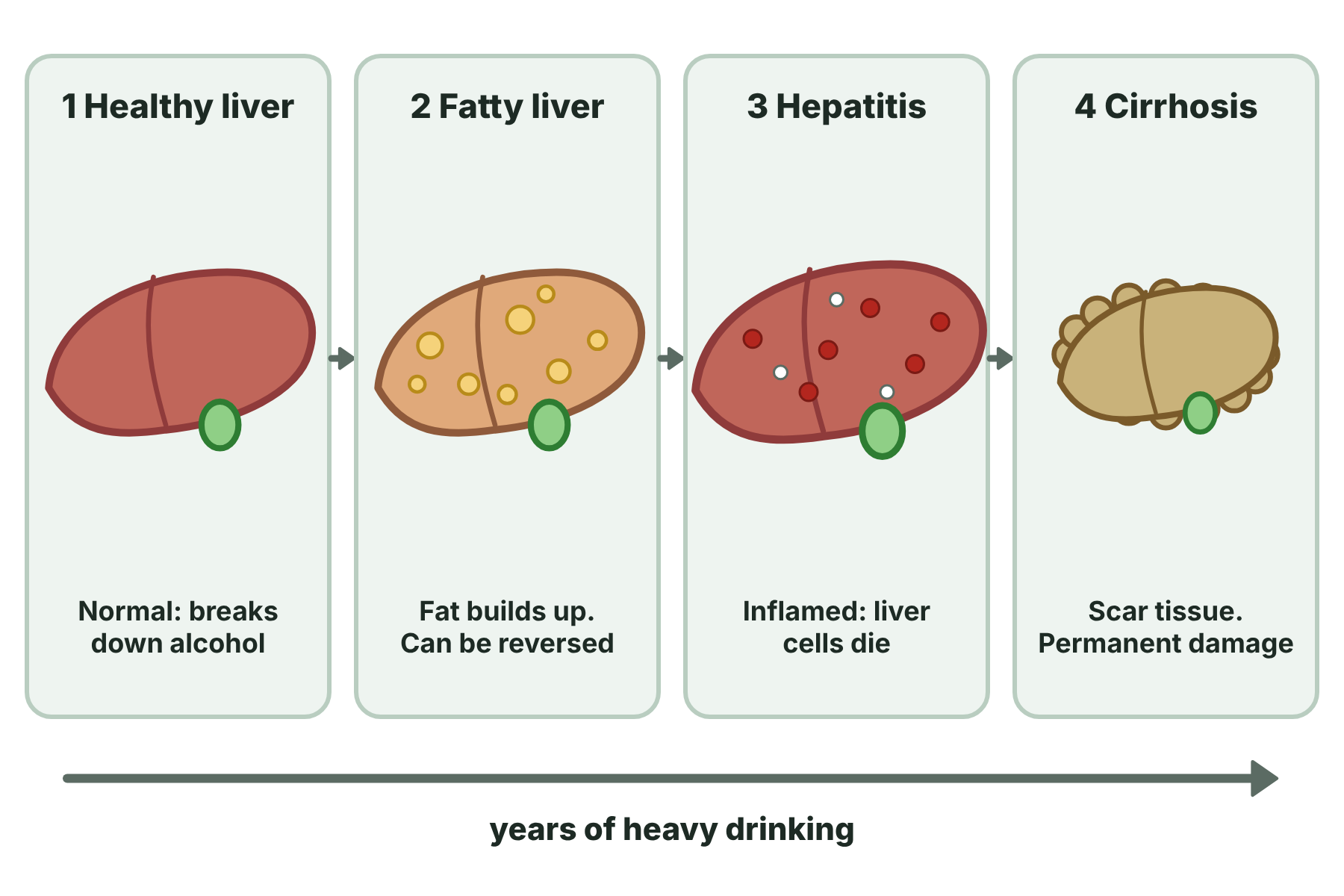 Four stages of alcohol-related liver disease: a healthy liver, a fatty liver, alcoholic hepatitis and cirrhosis, getting worse with years of heavy drinking.