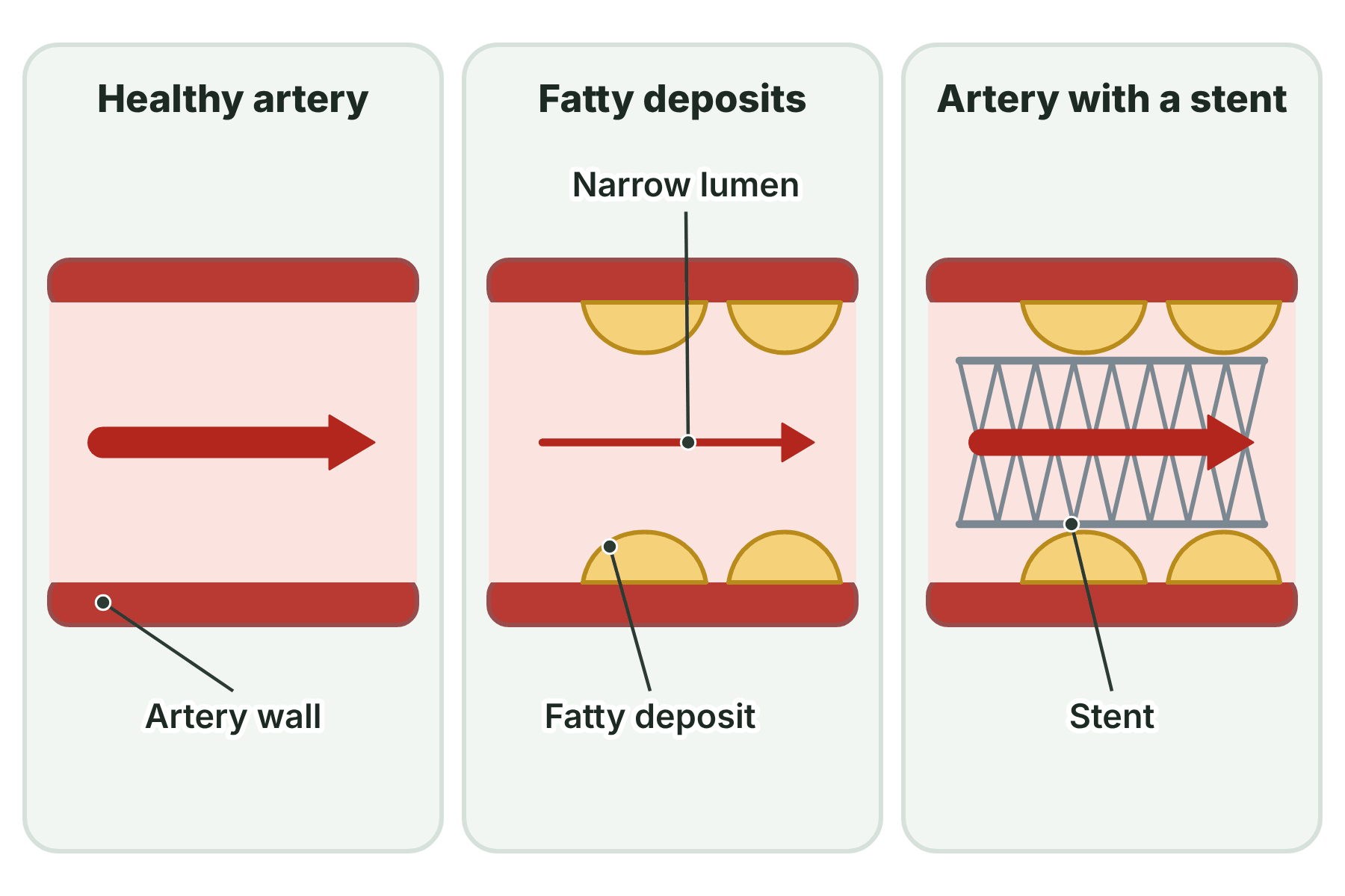 A healthy coronary artery, an artery narrowed by fatty deposits and an artery held open by a stent.