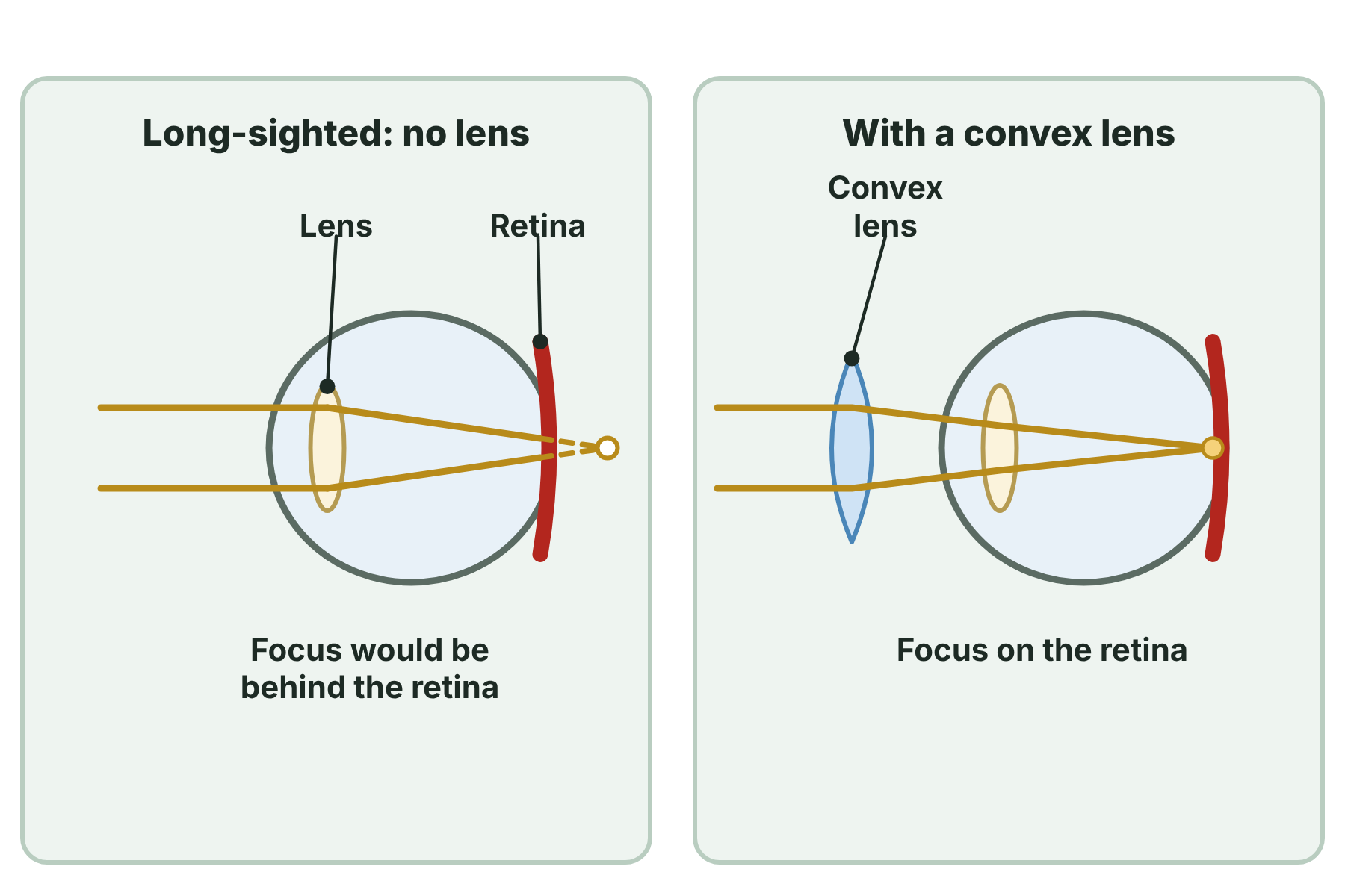 Rays that would focus behind the retina in a long-sighted eye, and focusing on the retina after a convex lens is added.