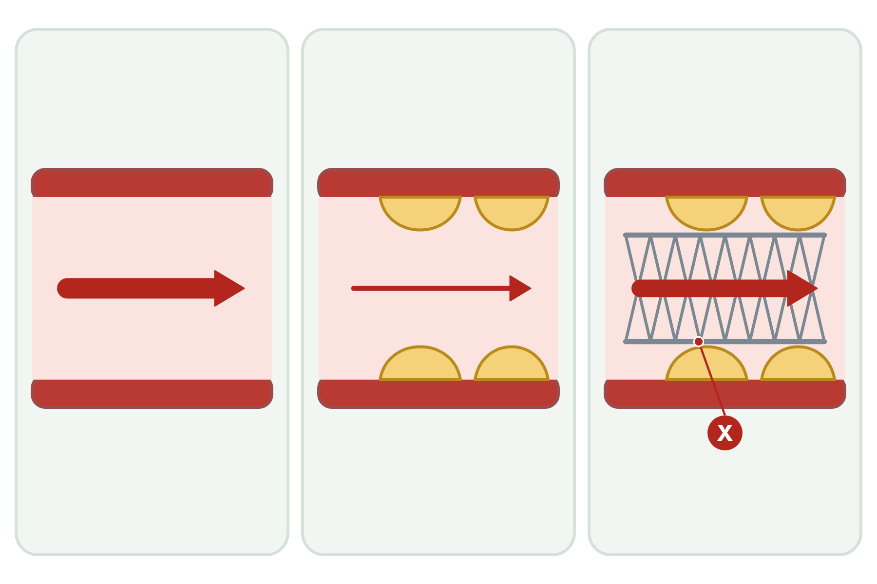 A healthy artery, a narrowed artery and a stented artery, with a pointer marked X to the stent.