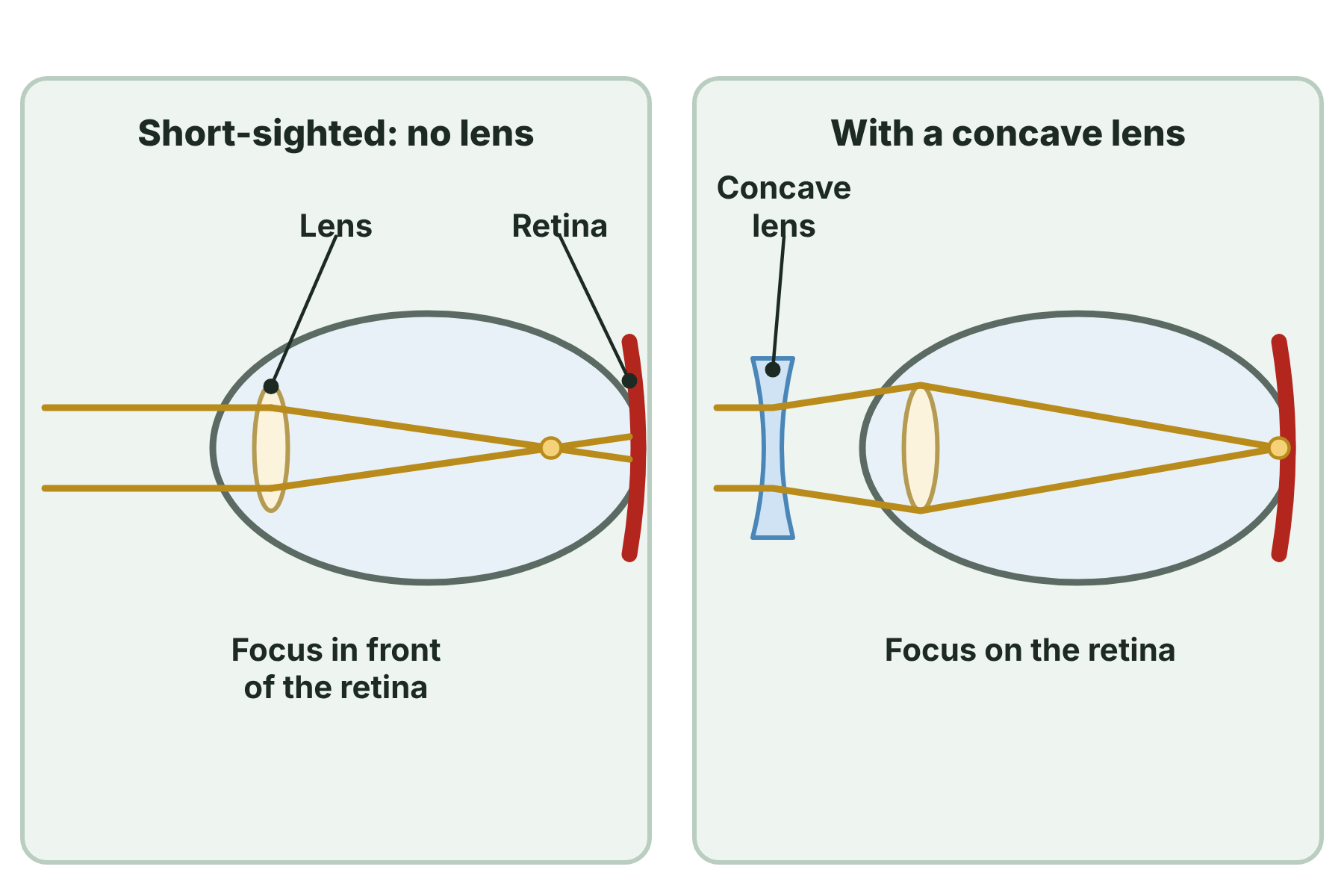 Rays focusing in front of the retina in a short-sighted eye, and focusing on the retina after a concave lens is added.