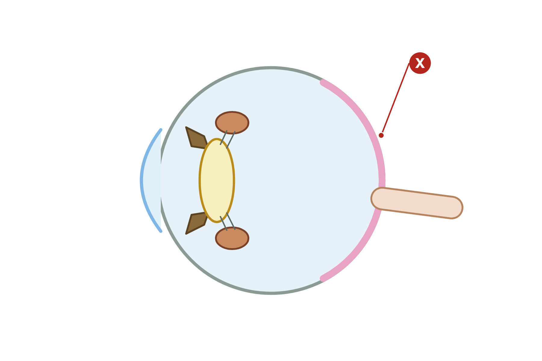 The eye in cross-section with a pointer marked X to the retina.