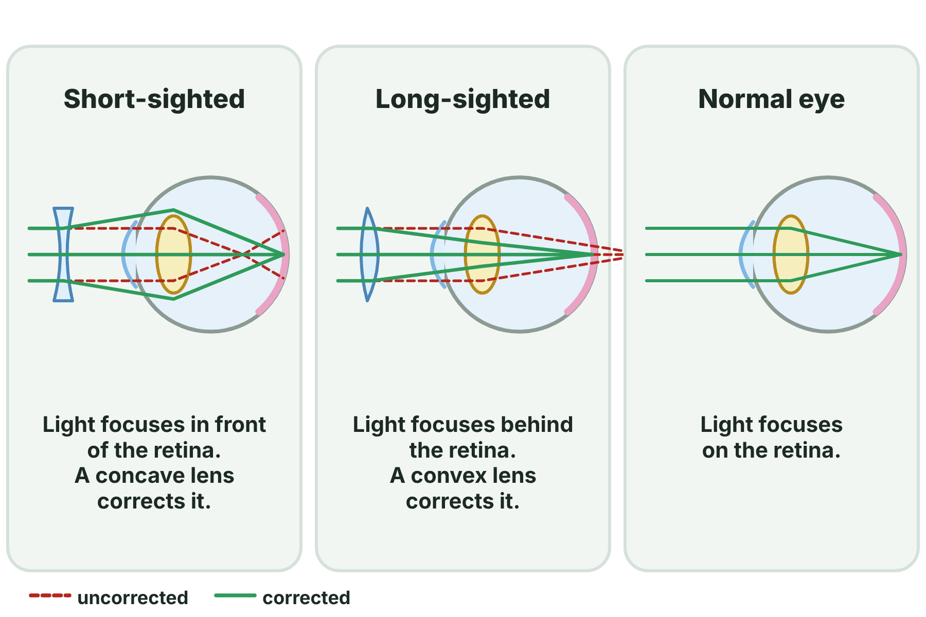 Light focusing in front of the retina in a short-sighted eye, behind the retina in a long-sighted eye, and on the retina in a normal eye, with the corrective lenses.
